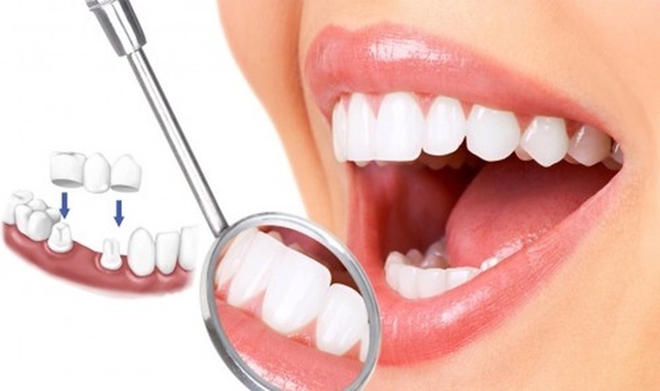Cầu răng sứ thẩm mỹ – Bí quyết giúp bạn sở hữu nụ cười hoàn hảo