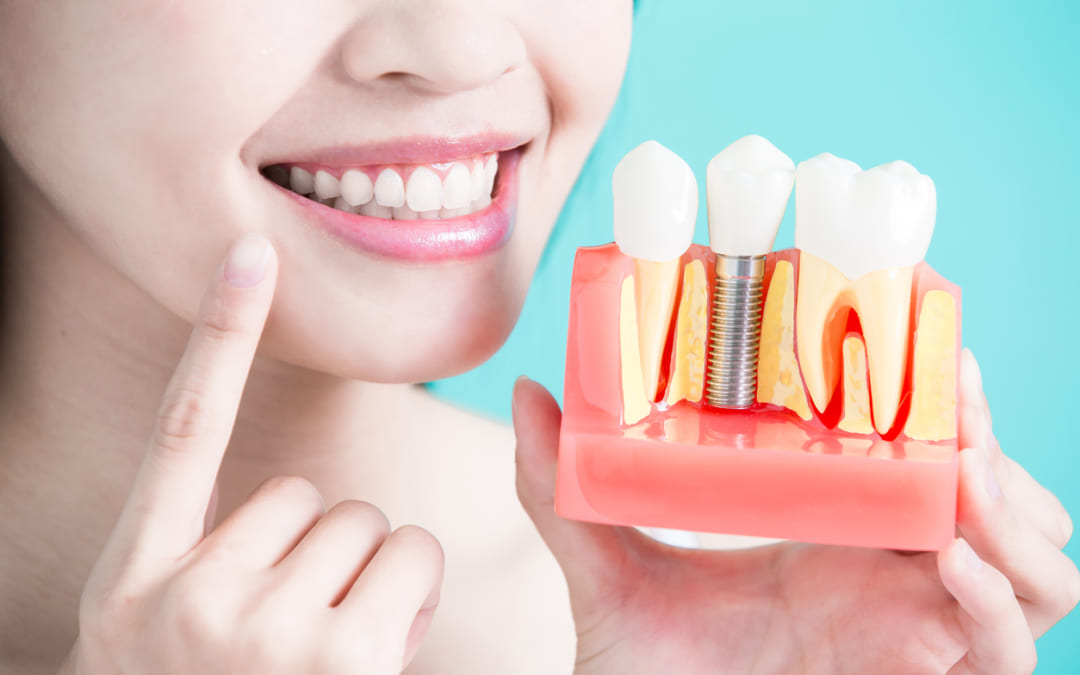 Trồng răng Implant – Giải pháp hoàn hảo khôi phục răng đã mất