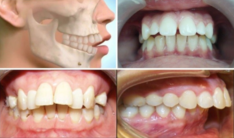 Các phương pháp hiệu quả chữa răng hô hiệu quả?