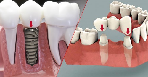 Người mất răng nên làm cầu răng sứ hay Implant? Địa chỉ trồng răng Implant uy tín