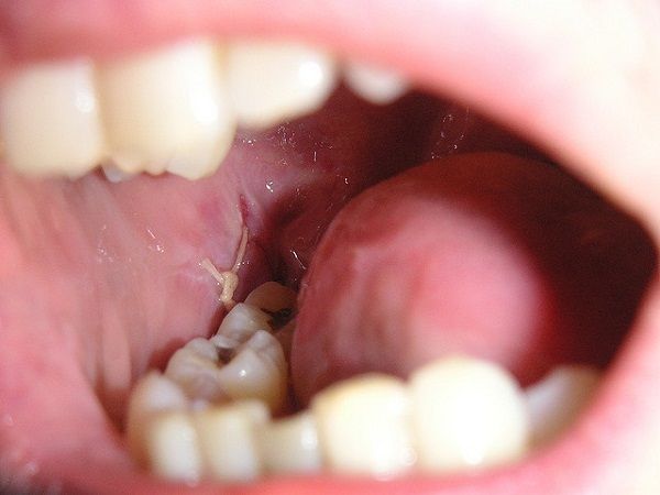 Nhổ răng khôn có được bảo hiểm không