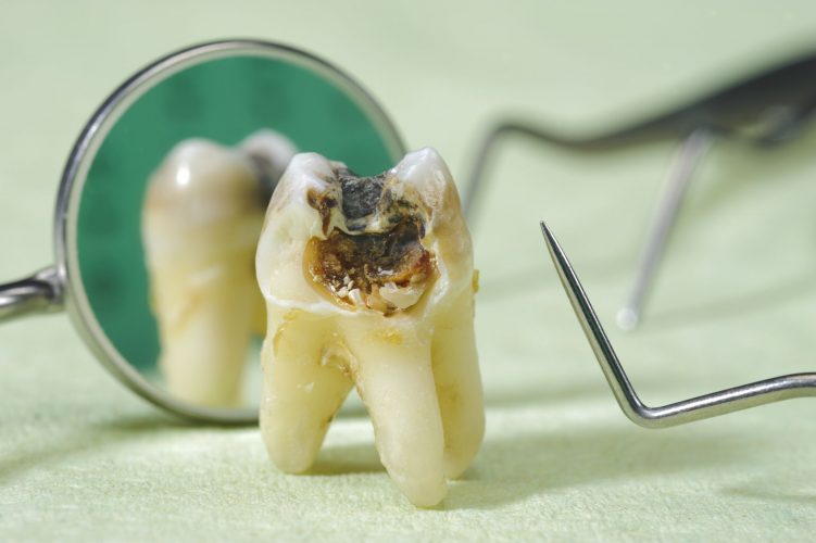Mức giá nhổ răng khôn chi tiết tại từng vị trí? Nhổ răng khôn ở đâu uy tín?