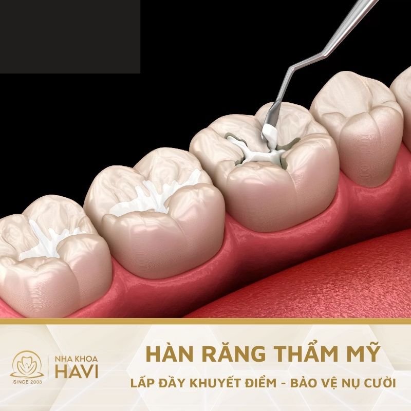 HÀN RĂNG THẨM MỸ – LẤP ĐẦY KHUYẾT ĐIỂM, BẢO VỆ NỤ CƯỜI