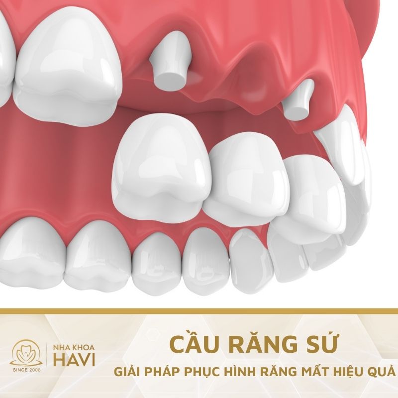 Có nên làm cầu răng sứ không? Những trường hợp nào nên làm cầu răng sứ