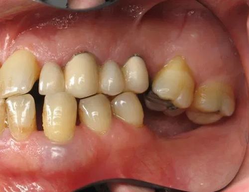Mất răng có ảnh hưởng gì không? Phương pháp khắc phục hiệu quả nhất