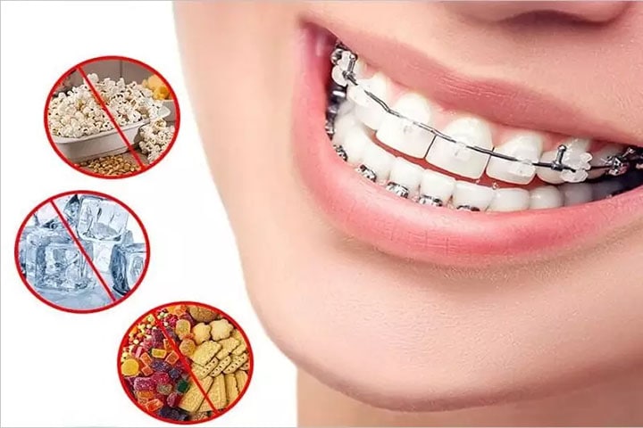 Niềng Răng Ăn Uống Như Thế Nào? Chăm Sóc Răng Miệng Hiệu Quả