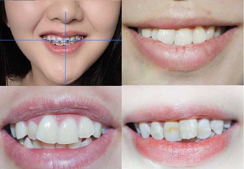 Niềng răng bị lệch mặt là do đâu? Cách khắc phục tình trạng này là gì?