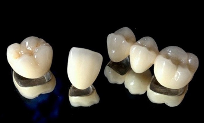 Răng sứ titan có mấy loại? Các loại răng sứ titan phổ biến hiện nay