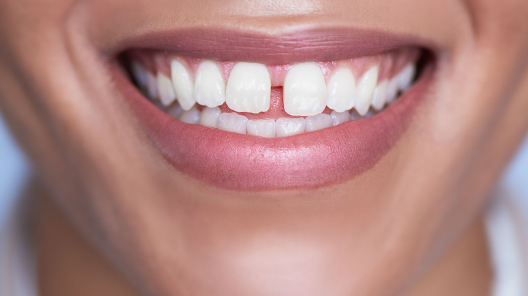 Răng thưa là gì? Tại sao cần phải khắc phục tình trạng răng thưa?