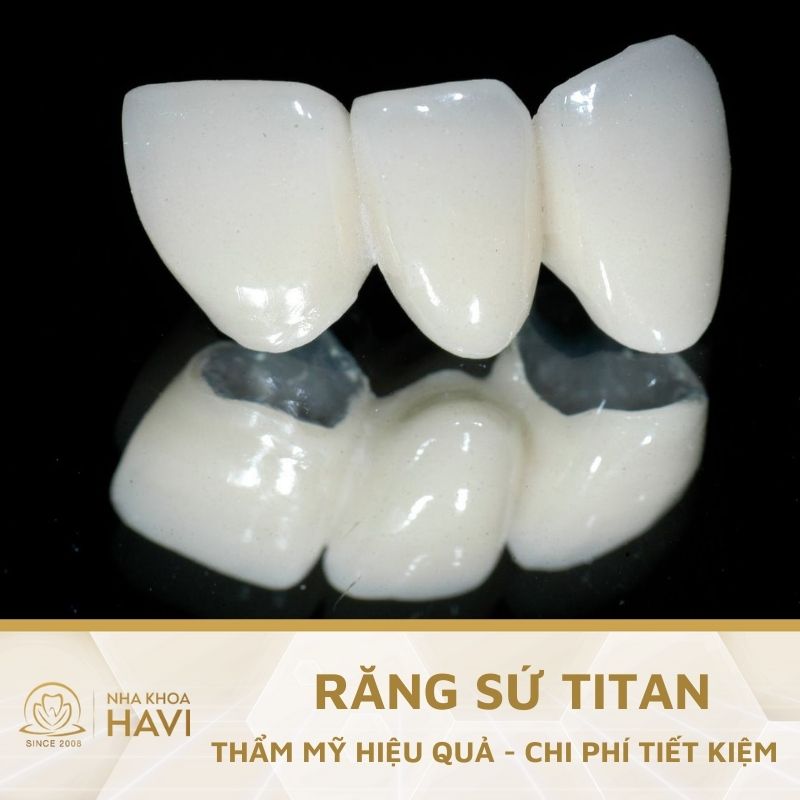 RĂNG SỨ TITAN – GIẢI PHÁP THẨM MỸ HIỆU QUẢ, CHI PHÍ TIẾT KIỆM