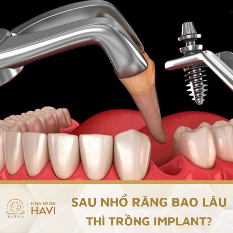 Sau khi nhổ răng bao lâu thì trồng Implant?