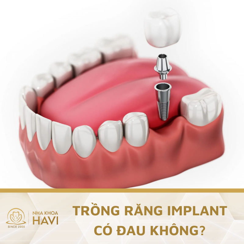 Trồng răng Implant có đau không? – Bác sĩ tại Nha khoa Havi giải đáp