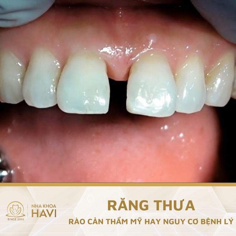 RĂNG THƯA LÀ GÌ? TẠI SAO CẦN KHẮC PHỤC RĂNG THƯA?