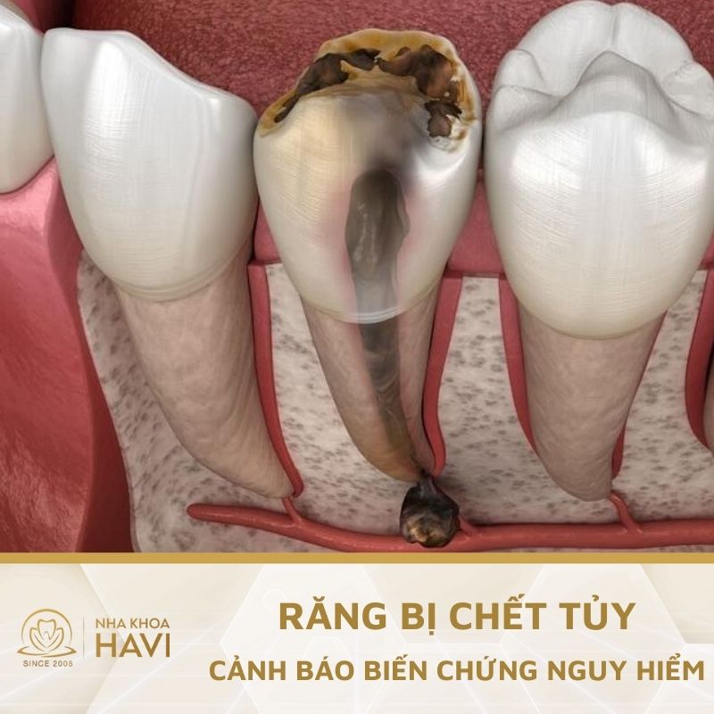 Răng bị chết tủy: Nguyên nhân, dấu hiệu và cách điều trị