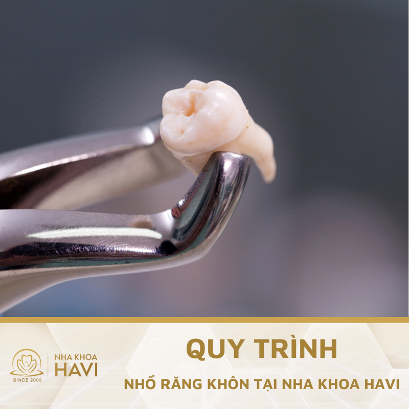 Khám phá về quy trình nhổ răng khôn an toàn tại Nha khoa Havi