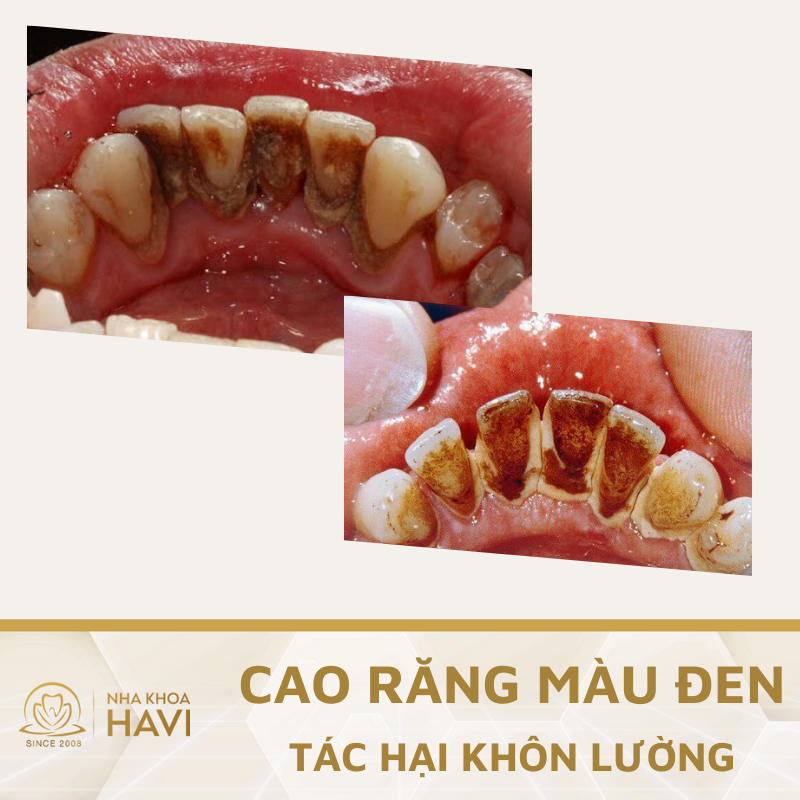 Cao răng màu đen – Tác hại khôn lường nếu không điều trị kịp thời